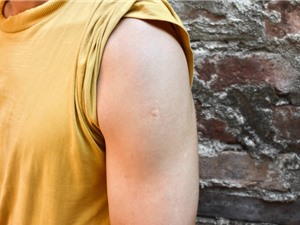 Vaccine mRNA có tiềm năng chống lại bệnh lao